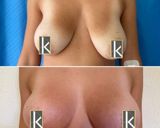 Bruststraffung-2-1030×1030